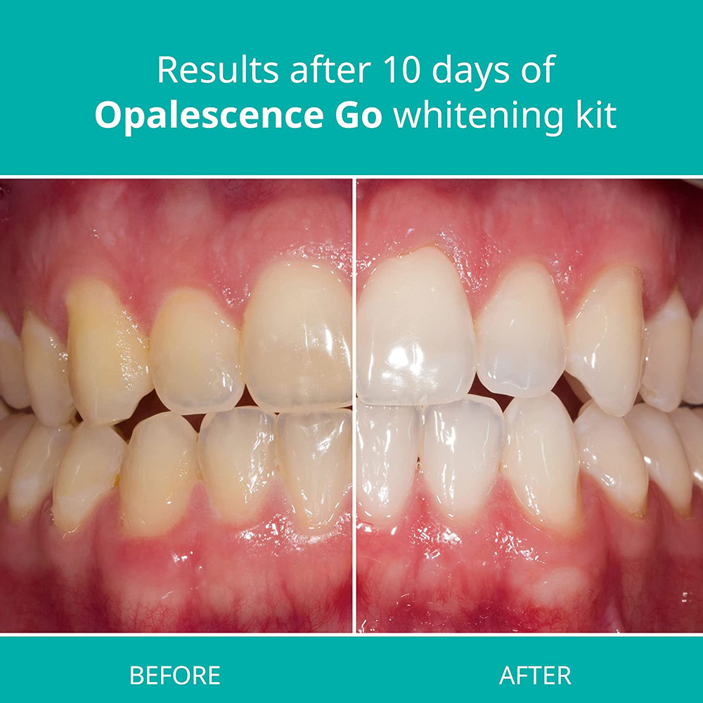 Opalescence Go Teeth Whitening - огляд і ціна Teeth Whitening Home Kit